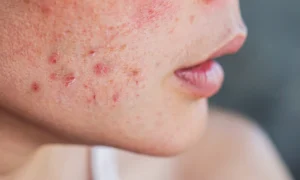 serum untuk kulit sensitif