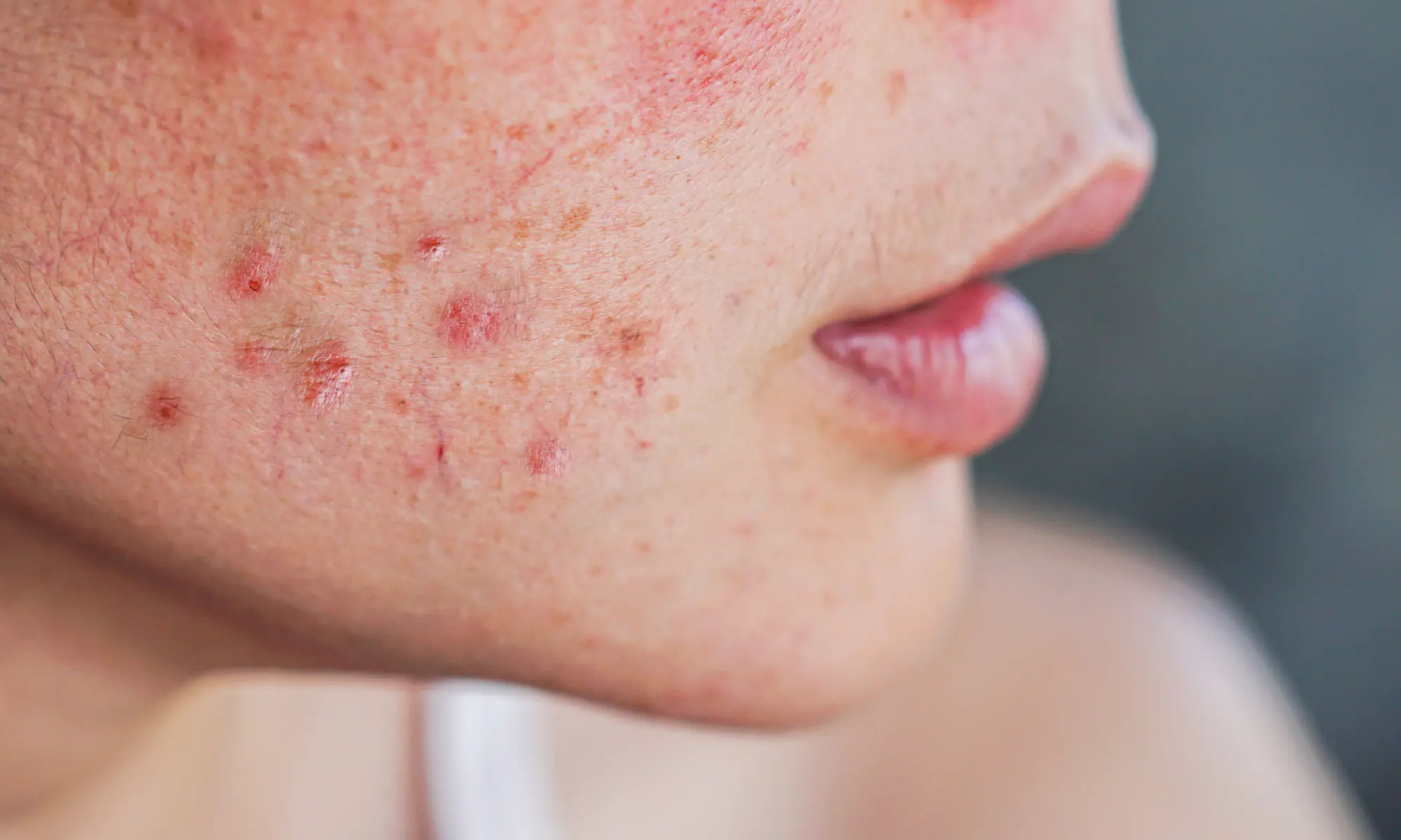 serum untuk kulit sensitif