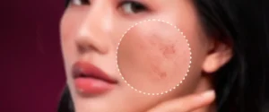 bye-bye-dark-spot-rahasia-tips-kulit-cerah-dan-bebas-noda-hitam