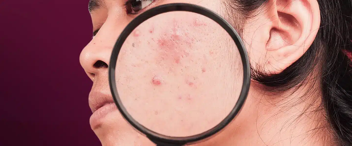 jenis-dan-penanganan-dark-spot-pada-wajah