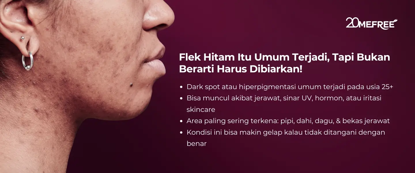 flek-hitam-umum-terjadi-tapi-bukan-brarti-harus-dibiarkan