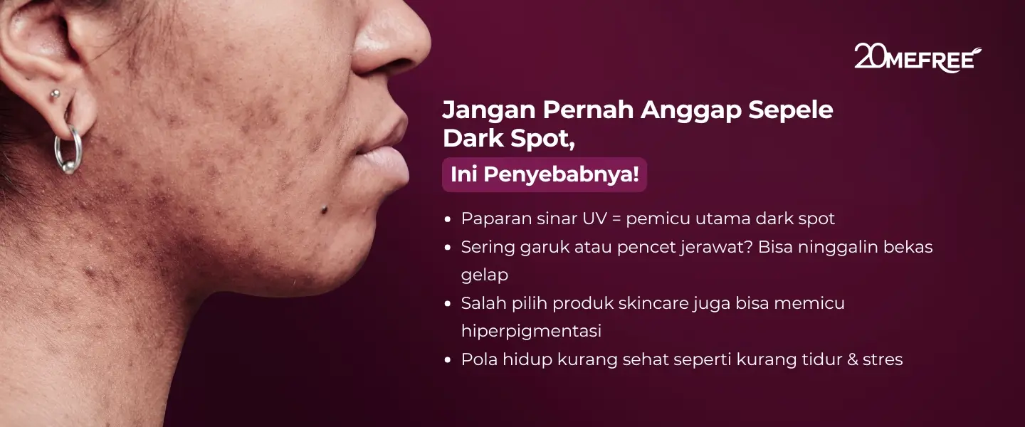 jangan-pernah-anggap-sepele-dark-spot-ini-penyebabnya